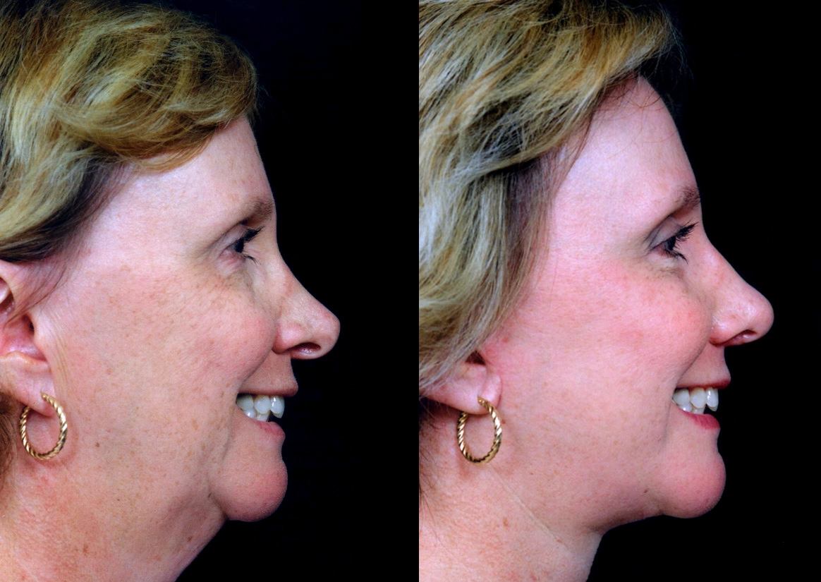 Facelift Newport Beach Cosmetic Facelift Case 5604-2
