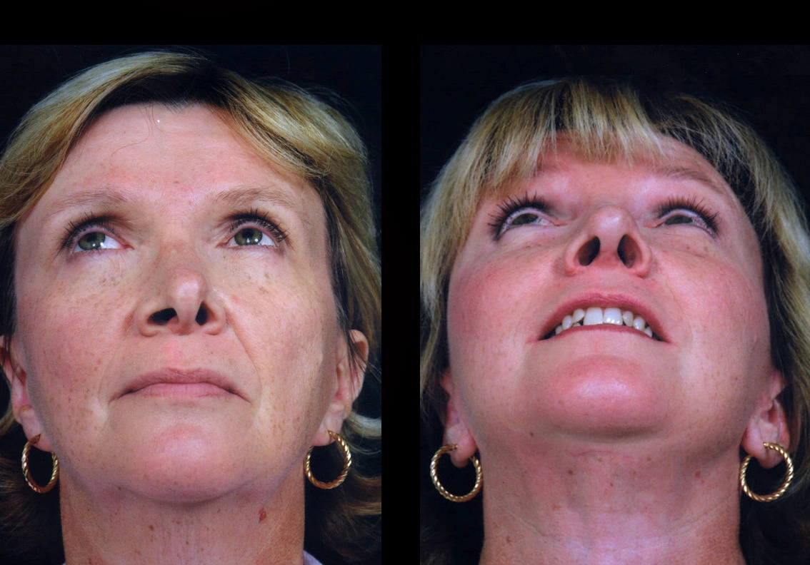 Facelift Newport Beach Cosmetic Facelift Case 5604-3