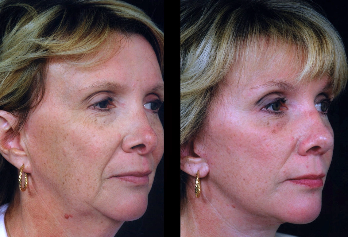 Facelift Newport Beach Cosmetic Facelift Case 5604-4