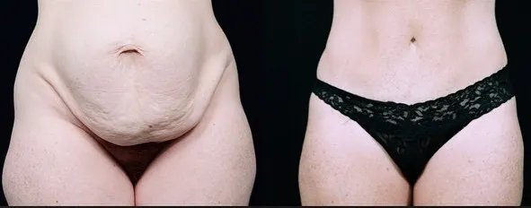 Abdominoplasty