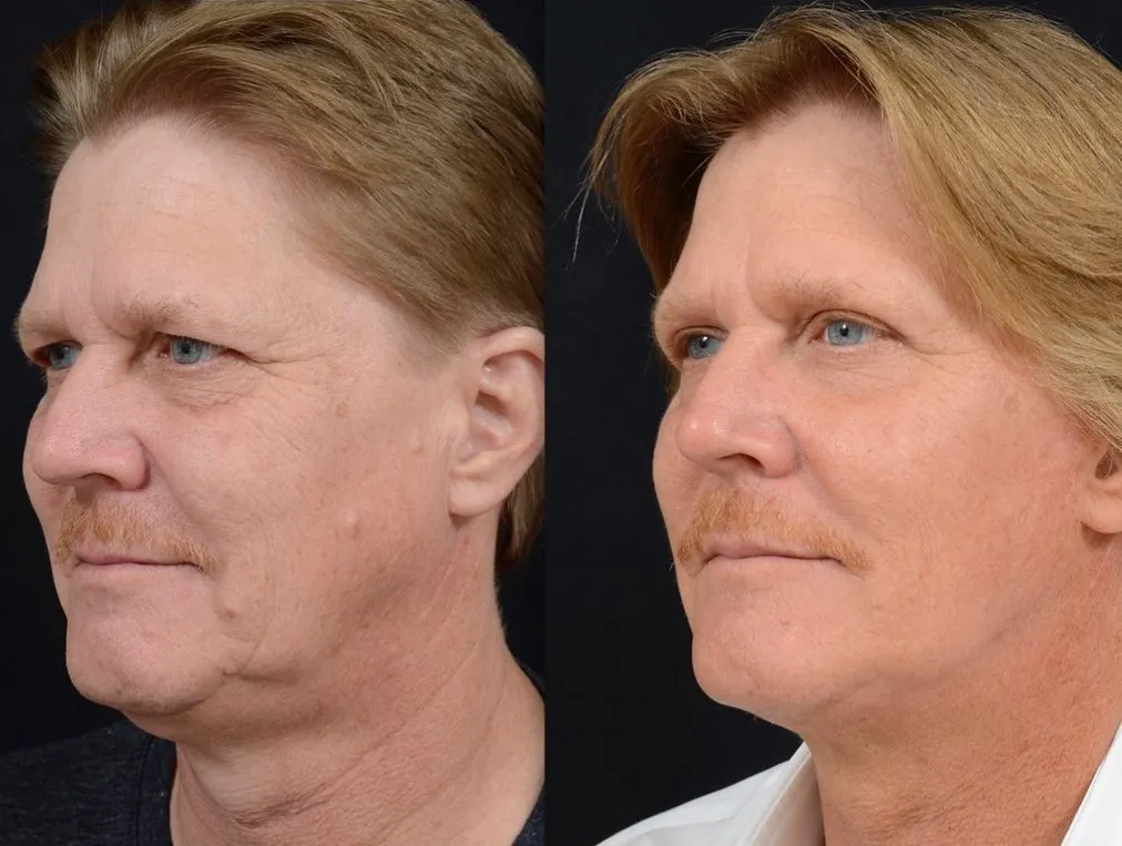 Eyelid & Facelift Surgery
