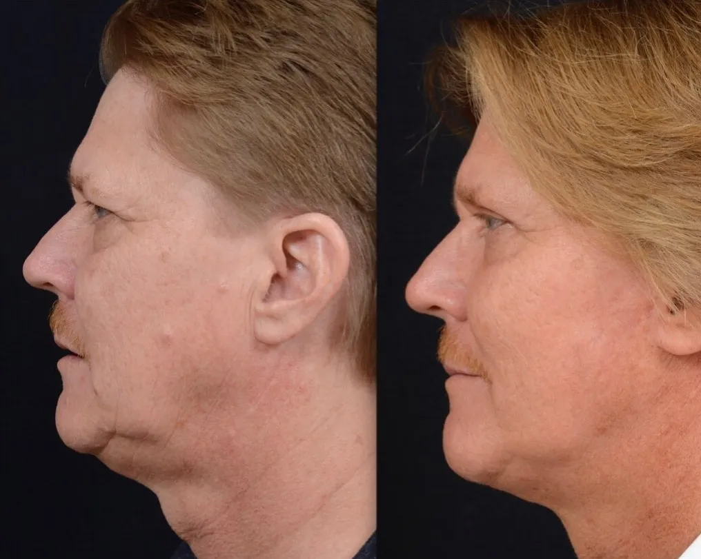 Eyelid & Facelift Surgery