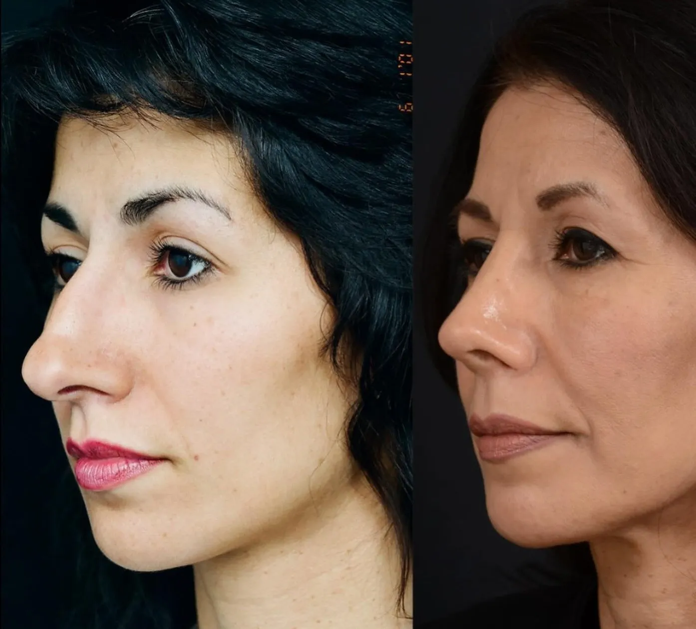 Rhinoplasty