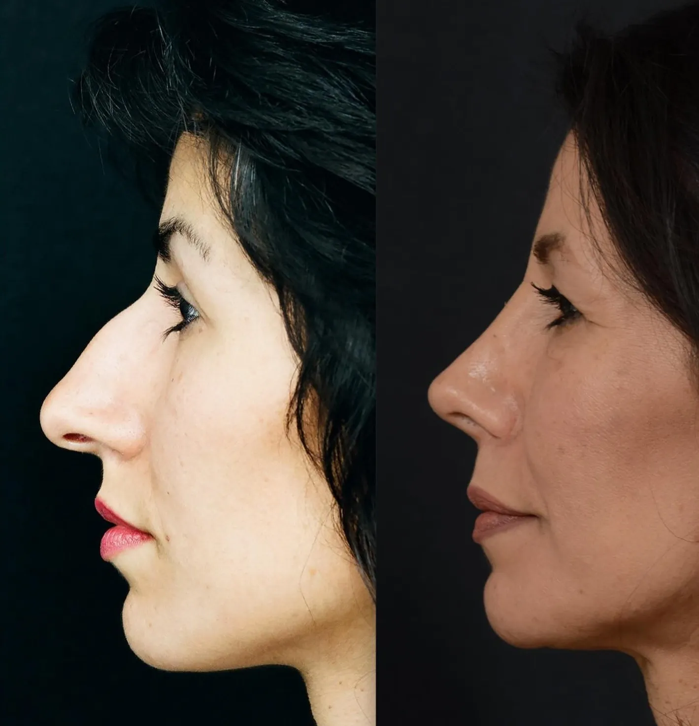 Rhinoplasty
