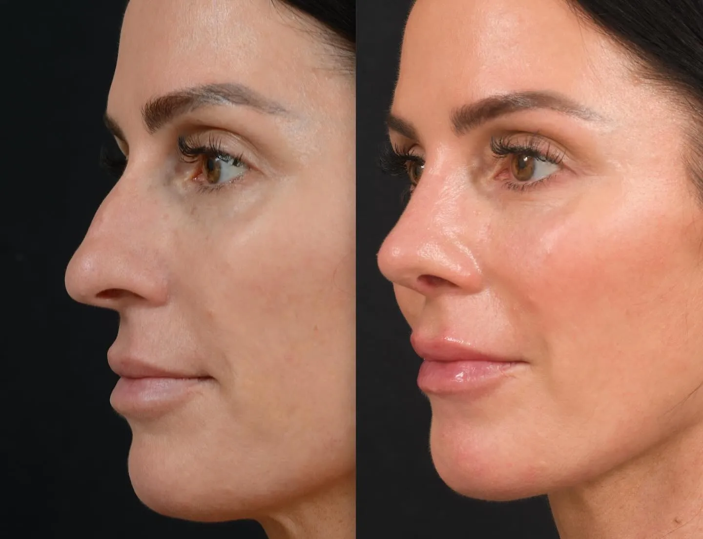 Rhinoplasty