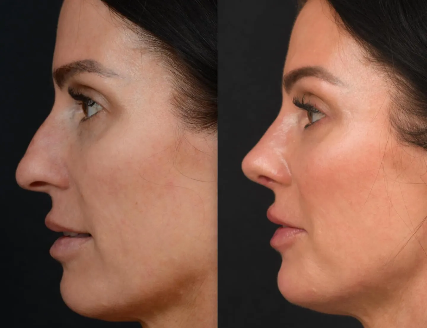 Rhinoplasty