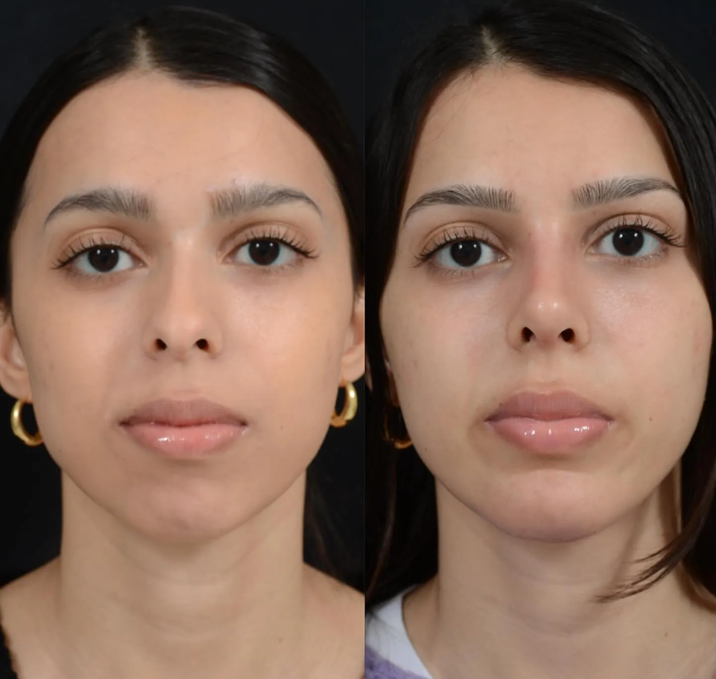 Rhinoplasty & Chin Augmentation