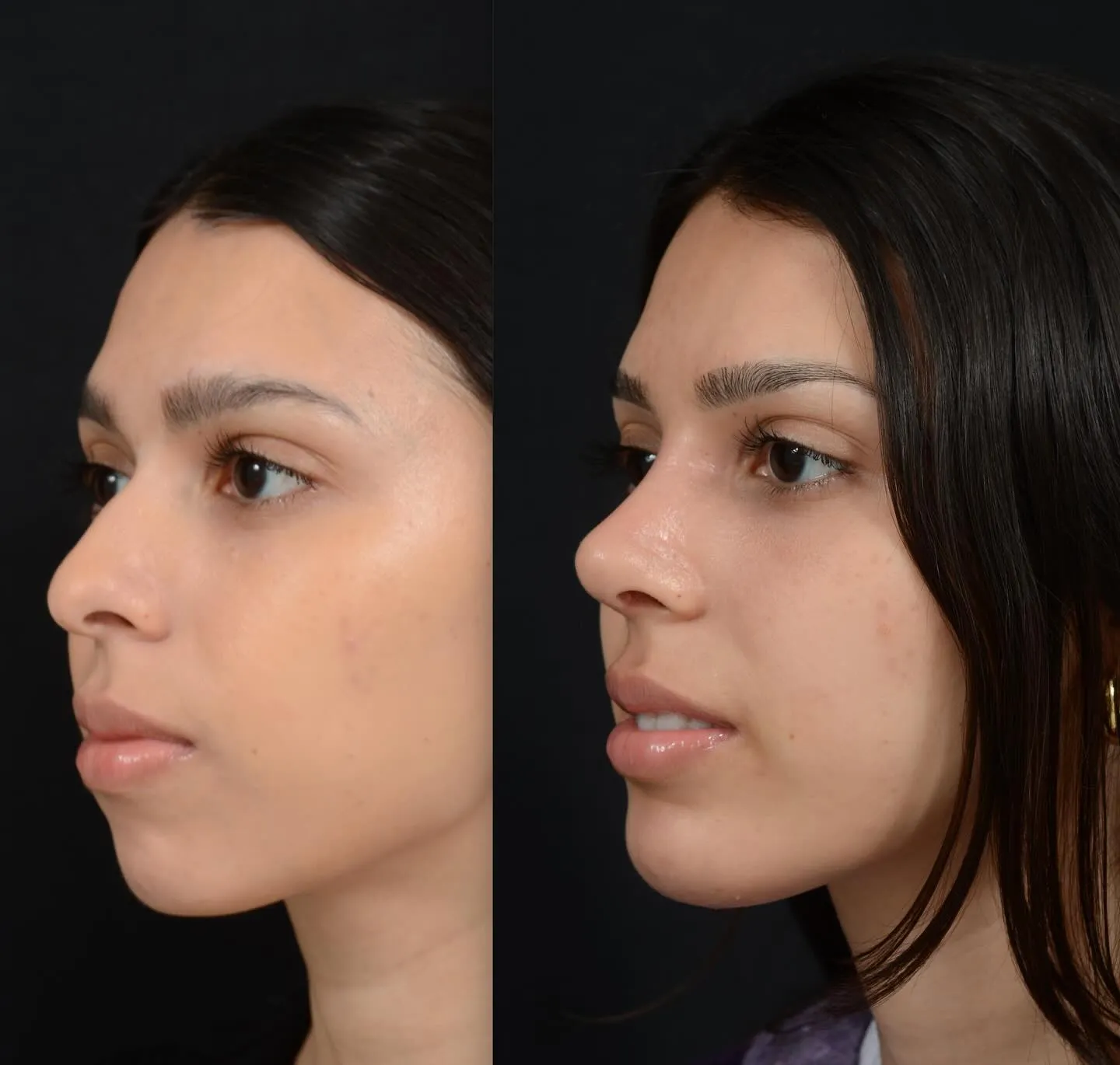 Rhinoplasty & Chin Augmentation
