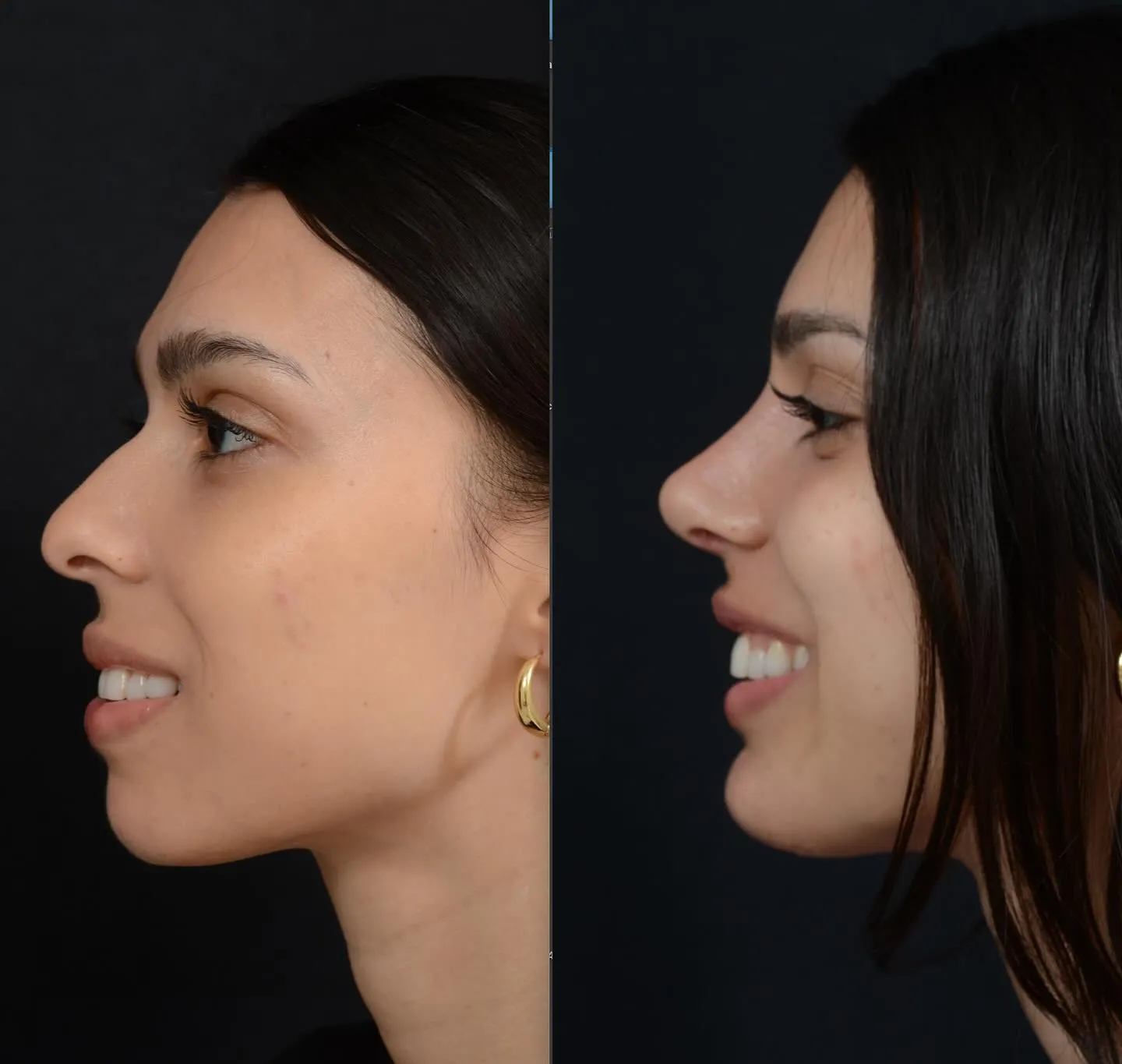 Rhinoplasty & Chin Augmentation