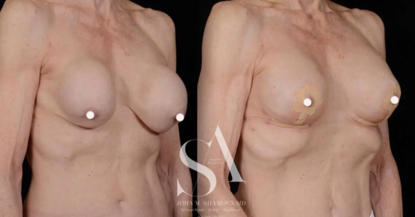 Breast Restoration