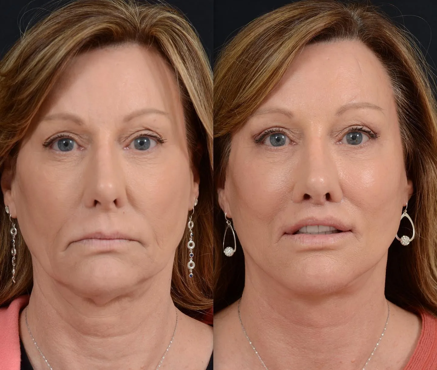 Face & Neck Lift