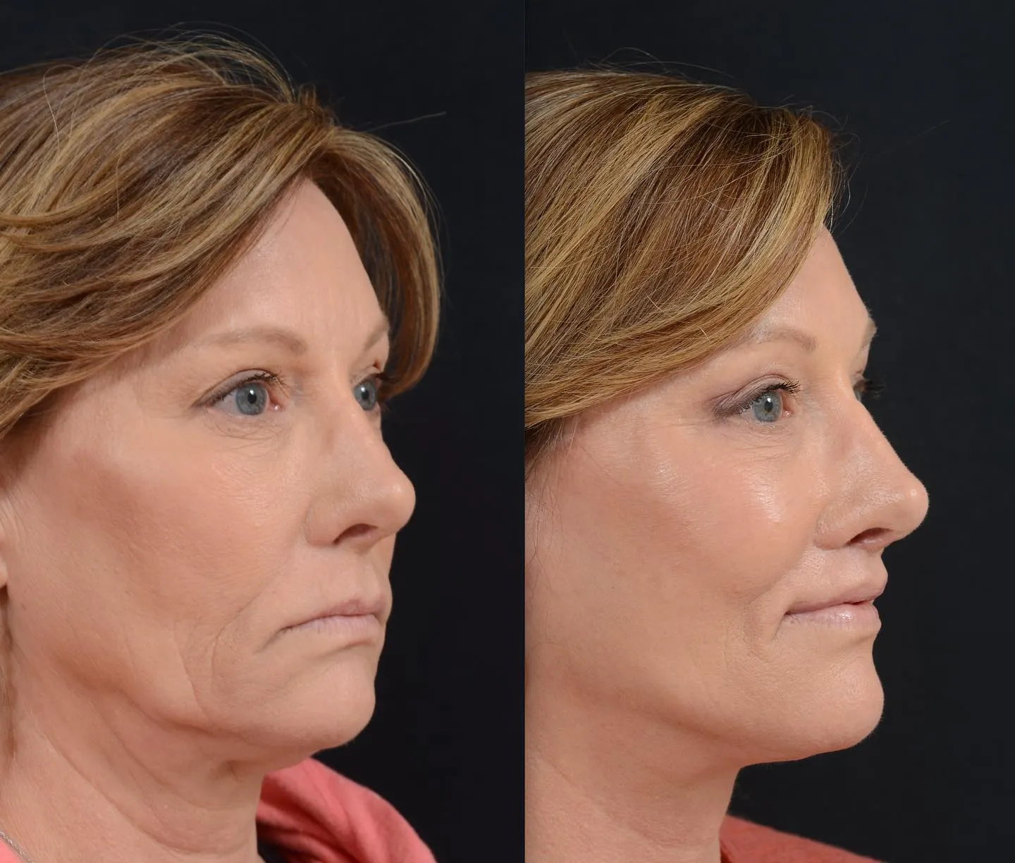 Face & Neck Lift