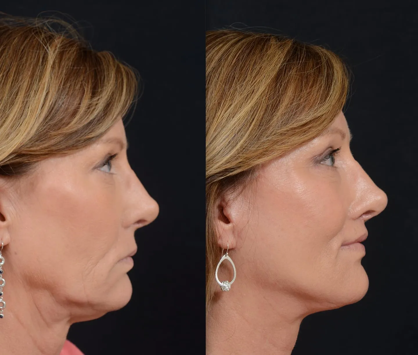 Face & Neck Lift