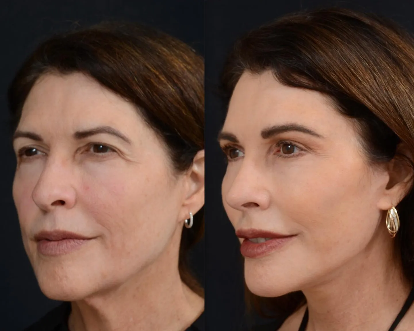 Facial Rejuvenation