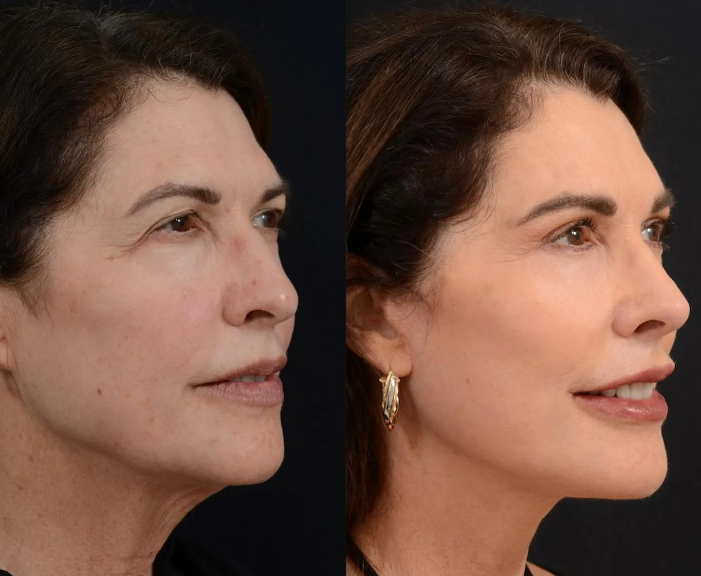 Facial Rejuvenation