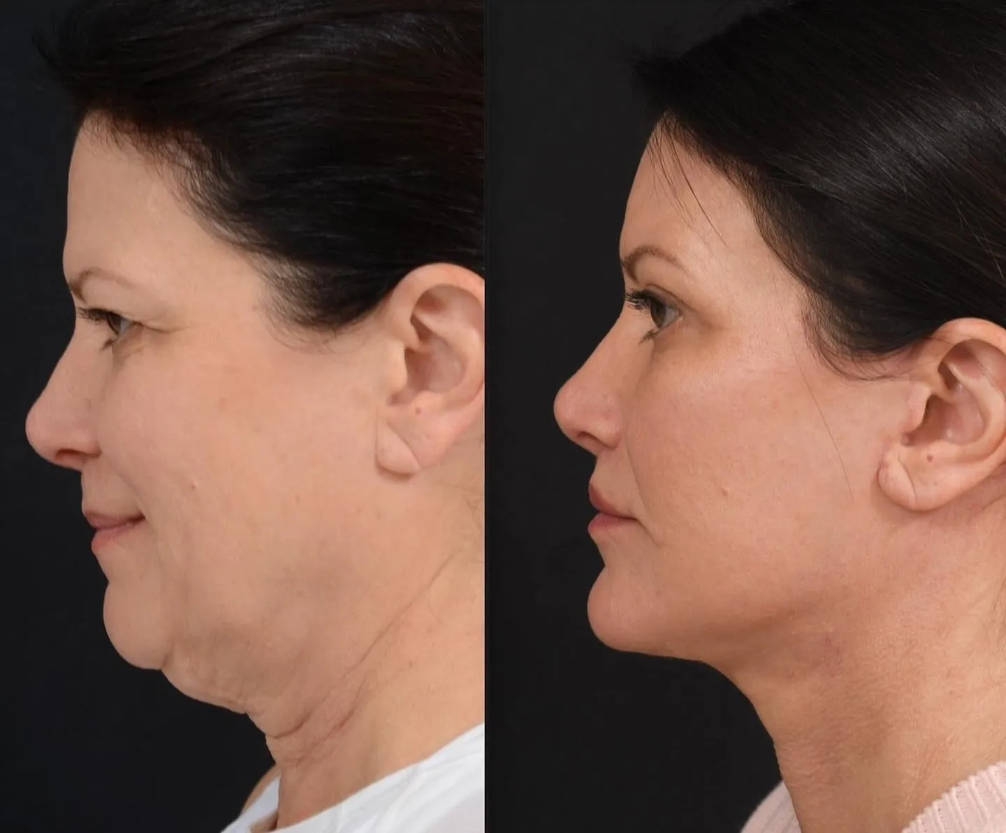 Facelift, Neck Lift & Eyelid Surgery
