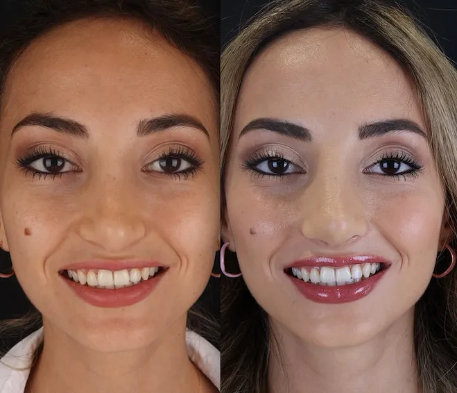 Revision Septo-Rhinoplasty