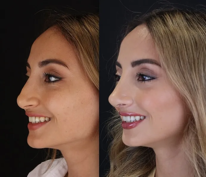 Revision Septo-Rhinoplasty