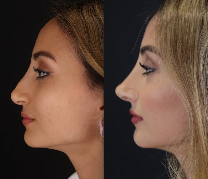 Revision Septo-Rhinoplasty