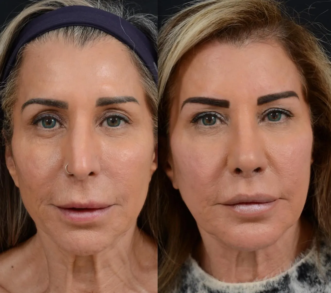 Rhinoplasty, Chin Augmentation & Lip Lift