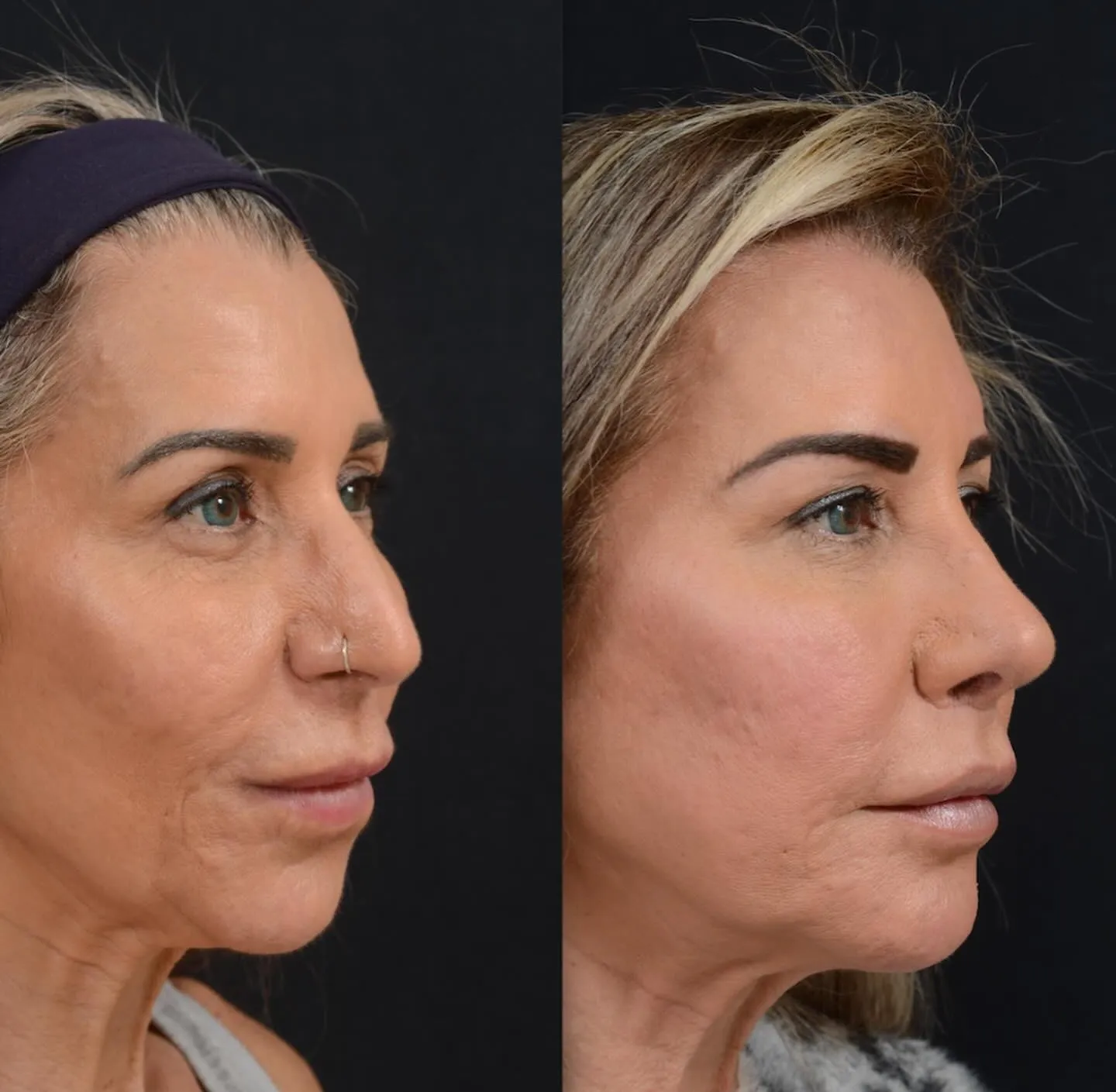 Rhinoplasty, Chin Augmentation & Lip Lift