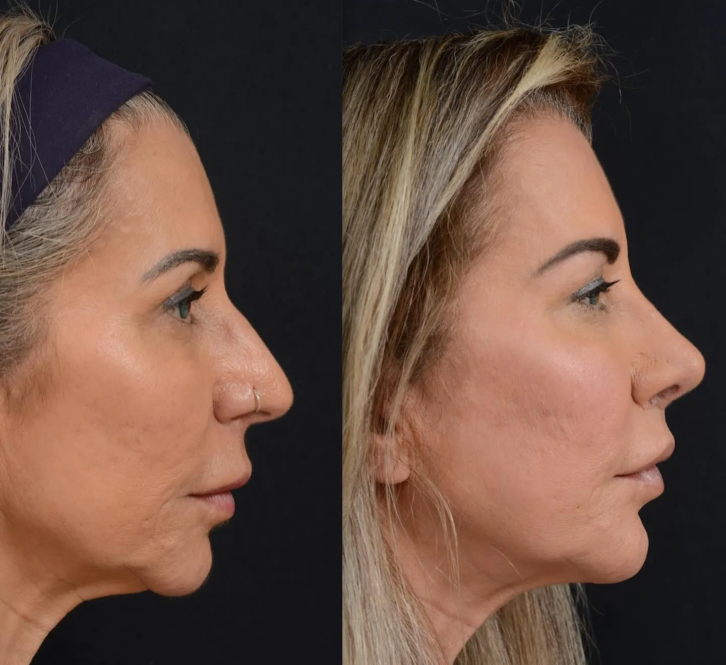 Rhinoplasty, Chin Augmentation & Lip Lift