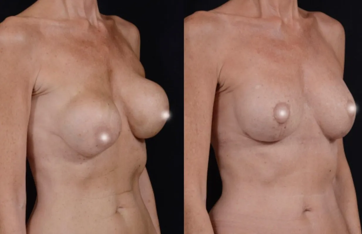 Breast Implant Revision & Lift