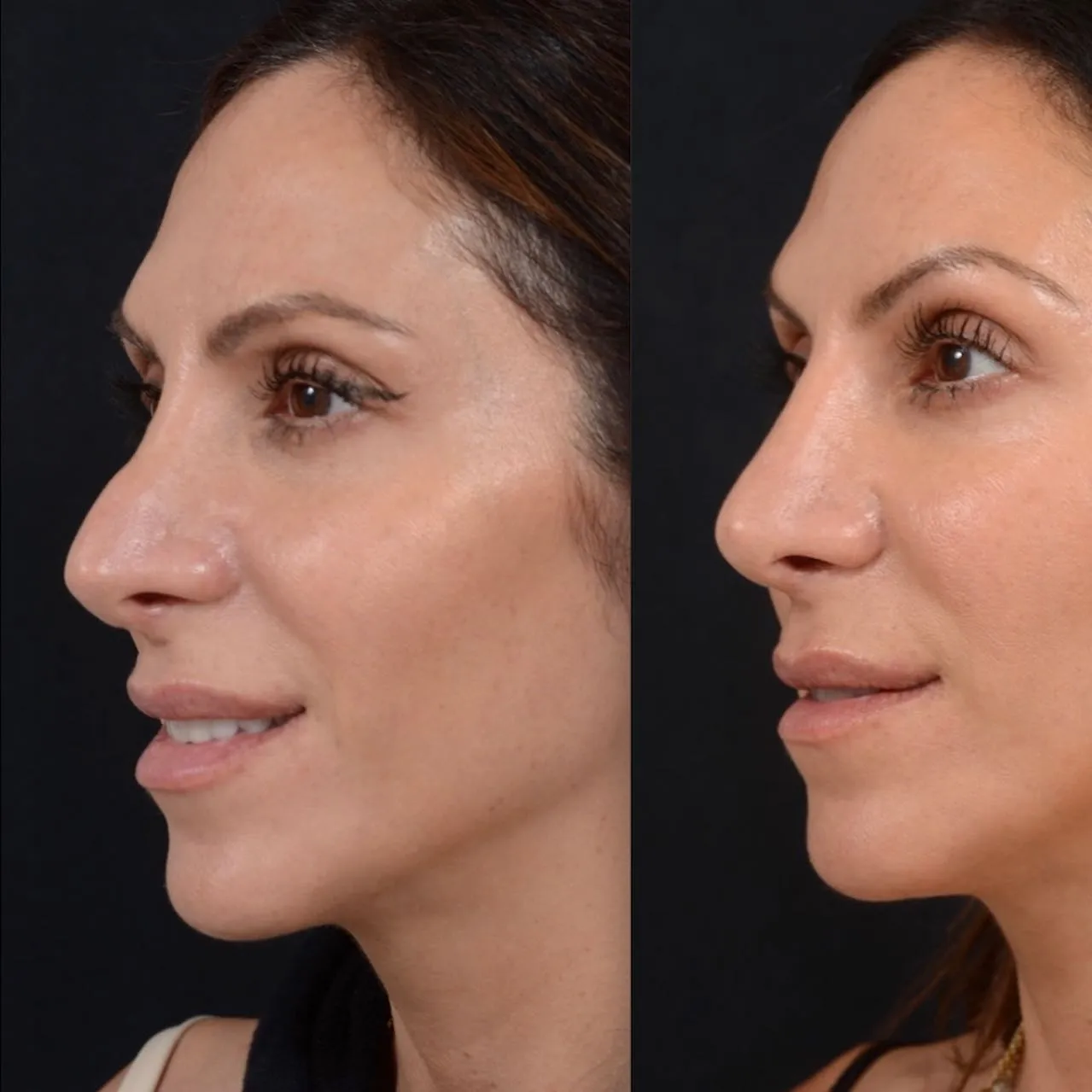 Symmetry Rhinoplasty Case 5938