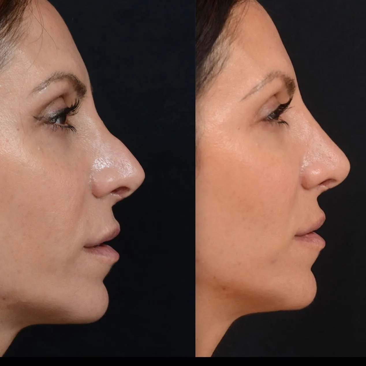 Symmetry Rhinoplasty Case 5938