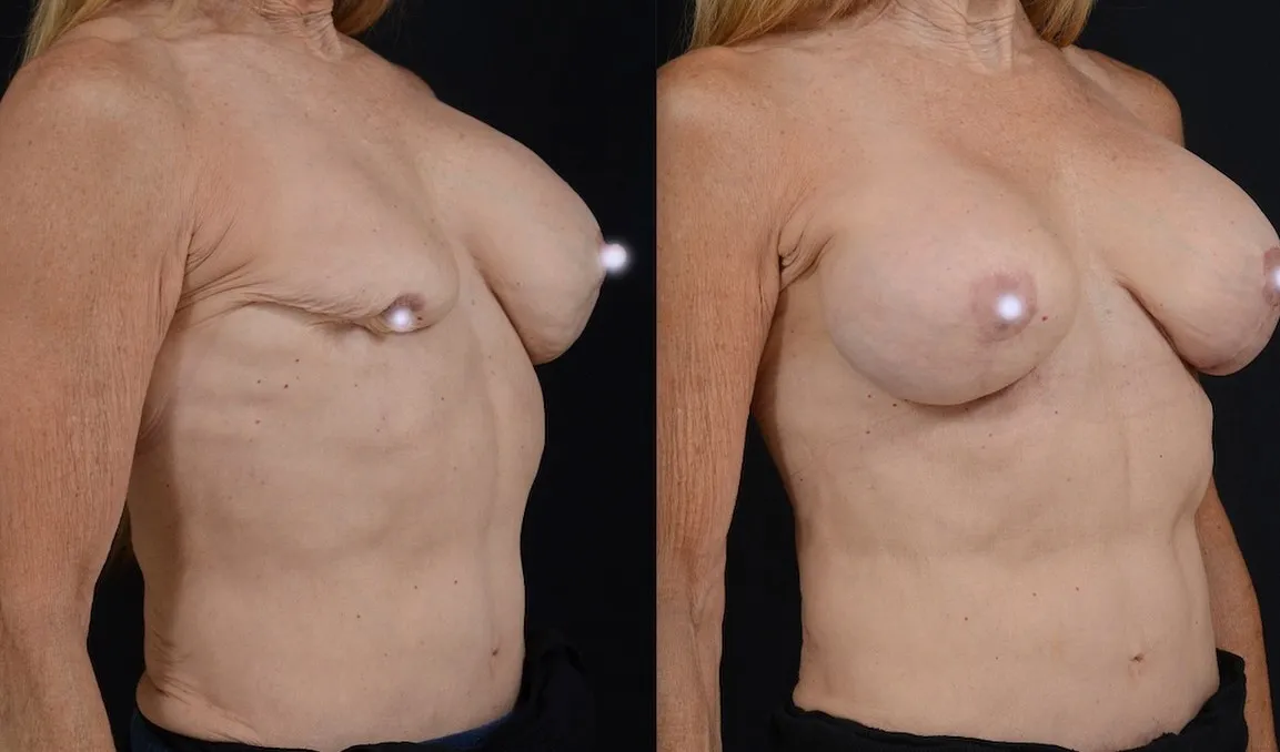 Breast Reconstruction