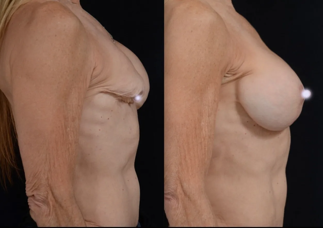 Breast Reconstruction