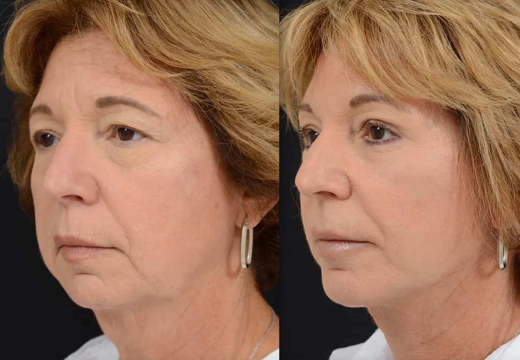 Face & Neck Lift with Blepharoplasty