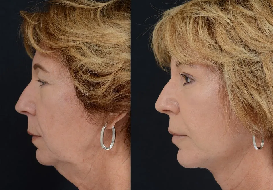 Face & Neck Lift with Blepharoplasty