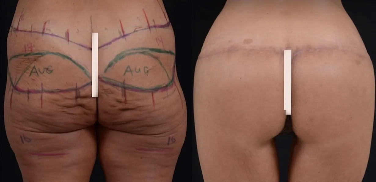 Body Lift & Buttock Augmentation