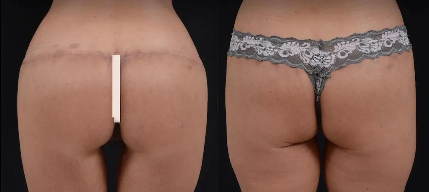 Body Lift & Buttock Augmentation