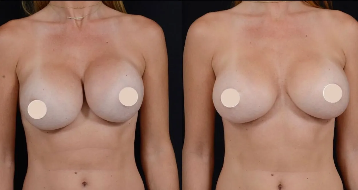 Breast Revision Surgery