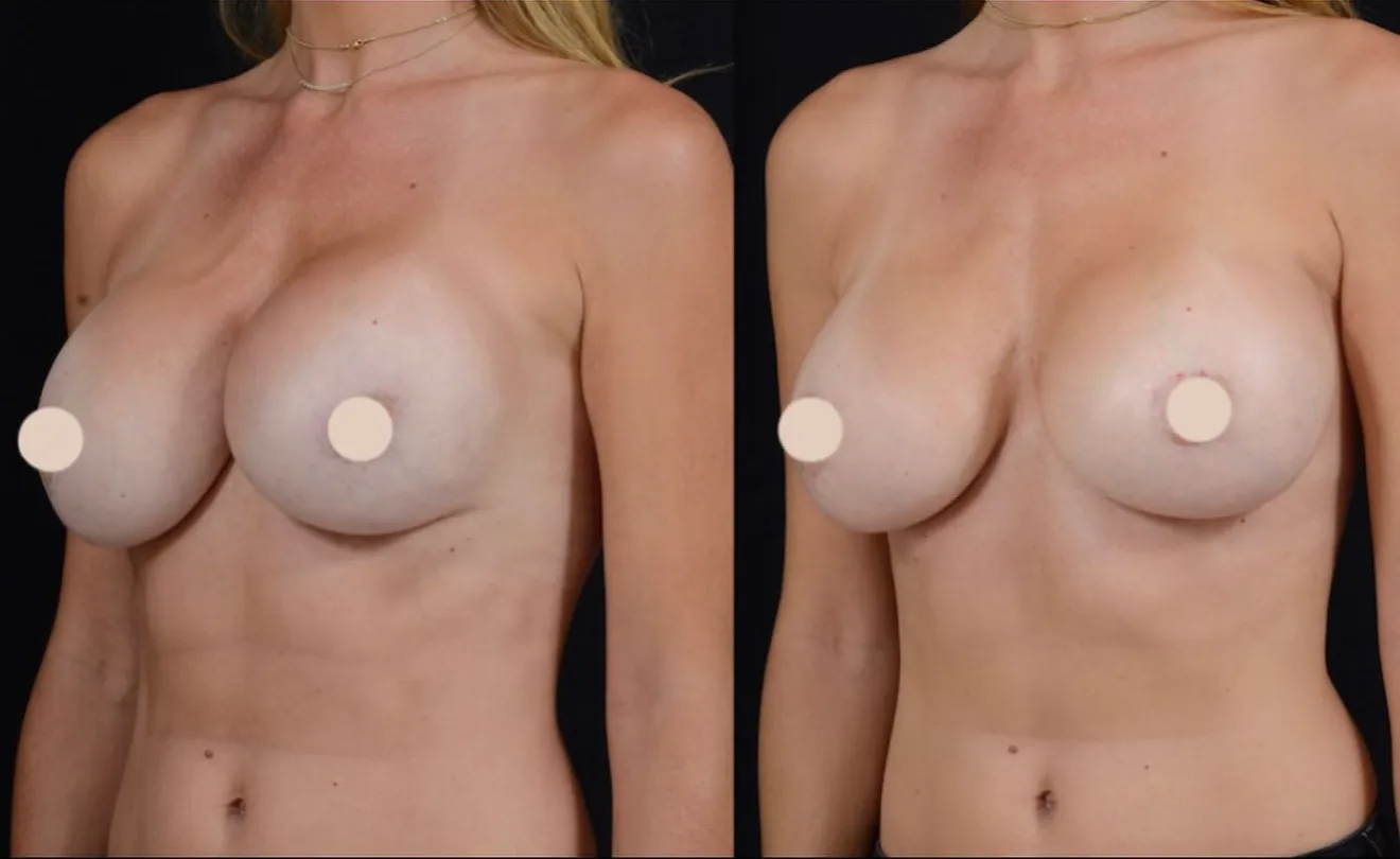 Breast Revision Surgery