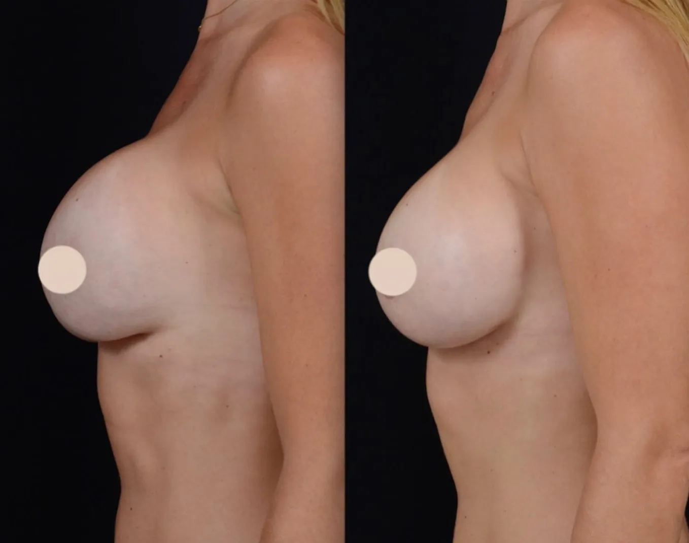Breast Revision Surgery