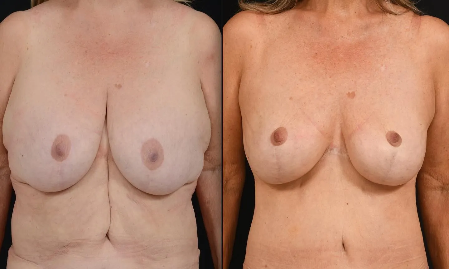 Body Contouring