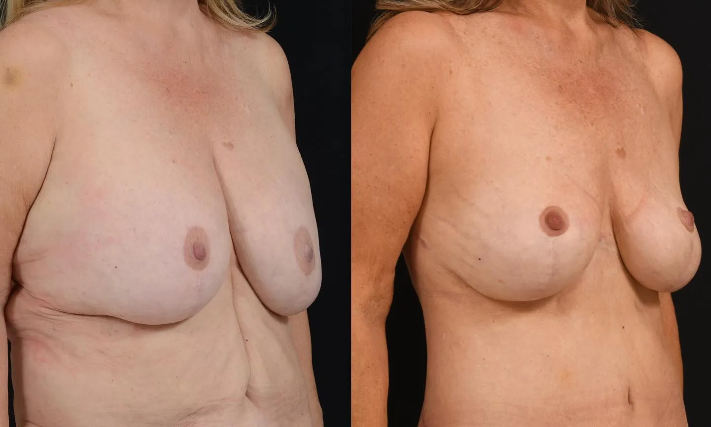 Body Contouring