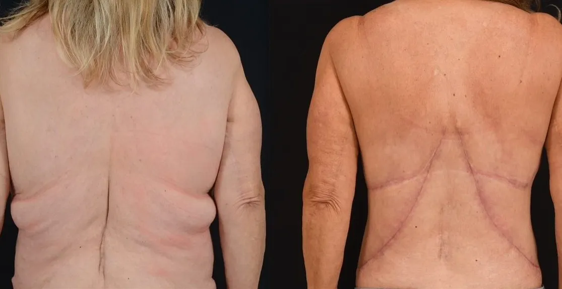 Body Contouring