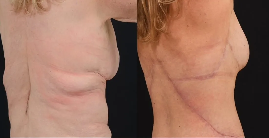 Body Contouring