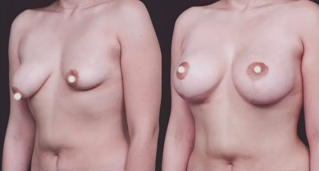 Breast Reconstruction