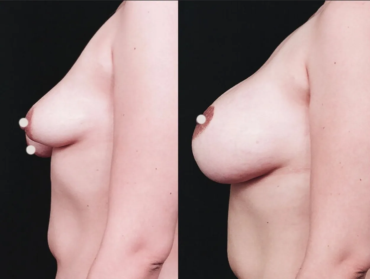 Breast Reconstruction