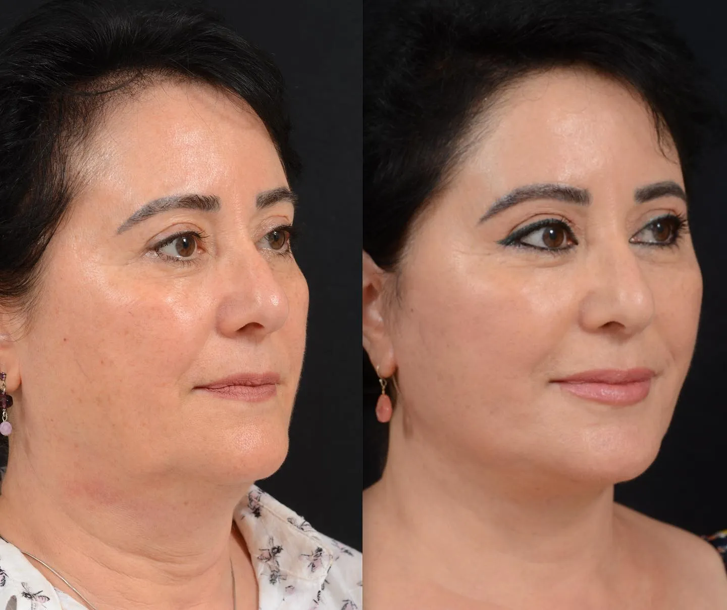 Facelift & Brow Lift