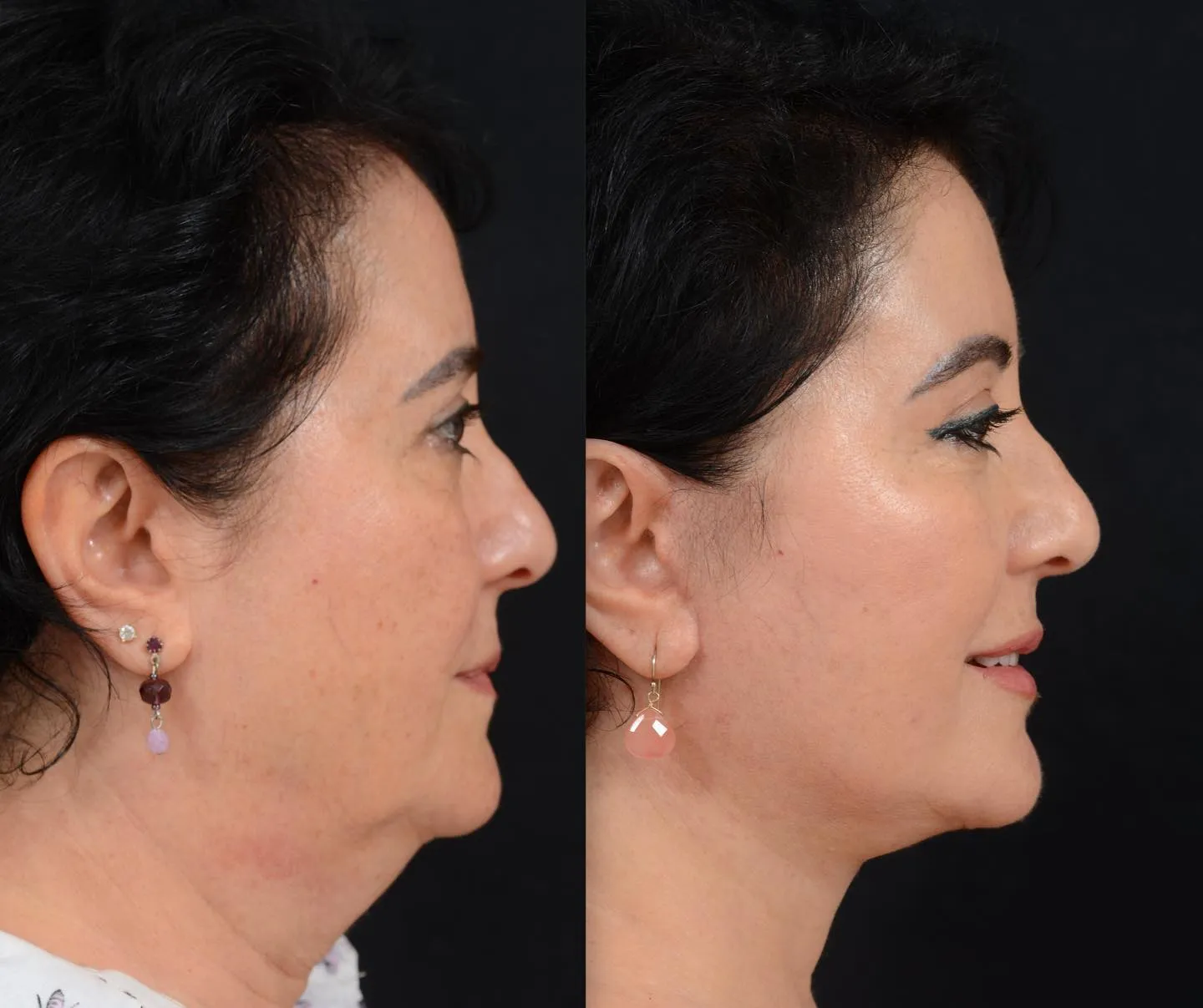 Facelift & Brow Lift