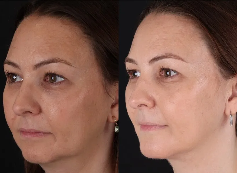 Chin Implant & Neck Liposuction