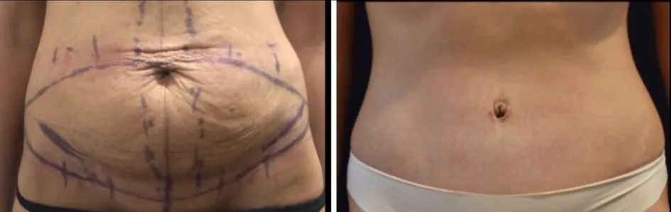 Abdominoplasty with Body Contouring