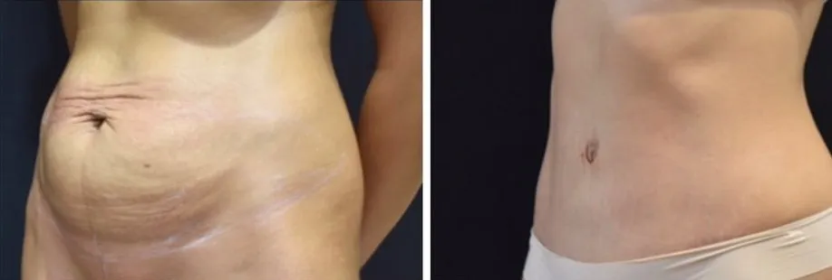Abdominoplasty with Body Contouring