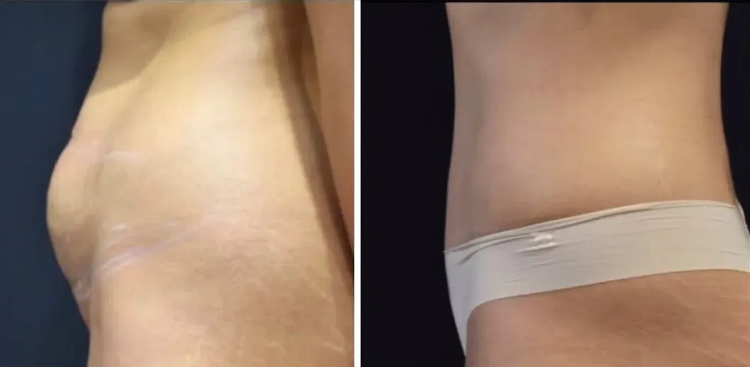 Abdominoplasty with Body Contouring